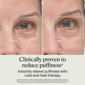 TheraFace wand used under eye reducing puffiness for refreshed look