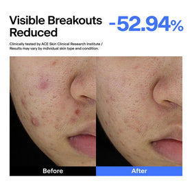 THOME ABC Serum applying to cheek with dropper, demonstrates targeted spot use