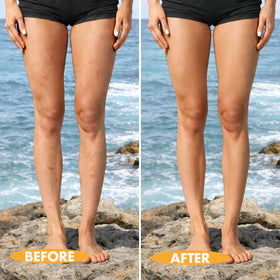 Timmi Beauty before and after leg coverage showing marked concealment
