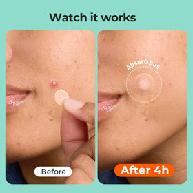 TKTK close-up of hydrocolloid texture highlighting absorbent, gentle material