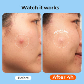 TKTK patch applied on cheek providing discreet daytime concealment