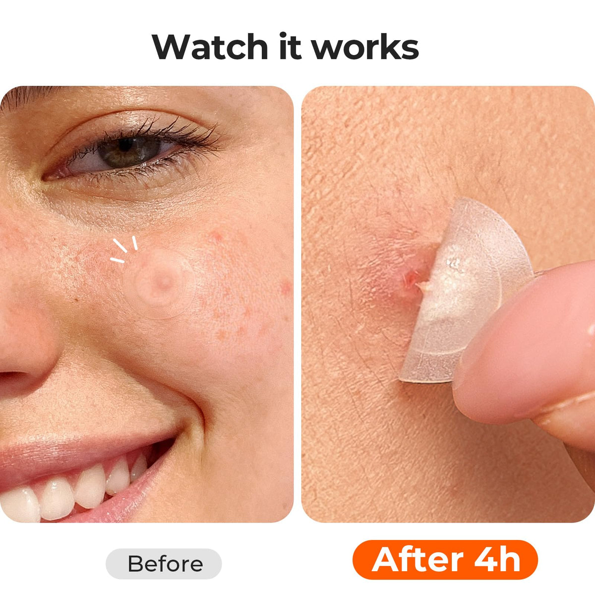 TKTK patch applied on skin, invisible and protecting a blemish discreetly