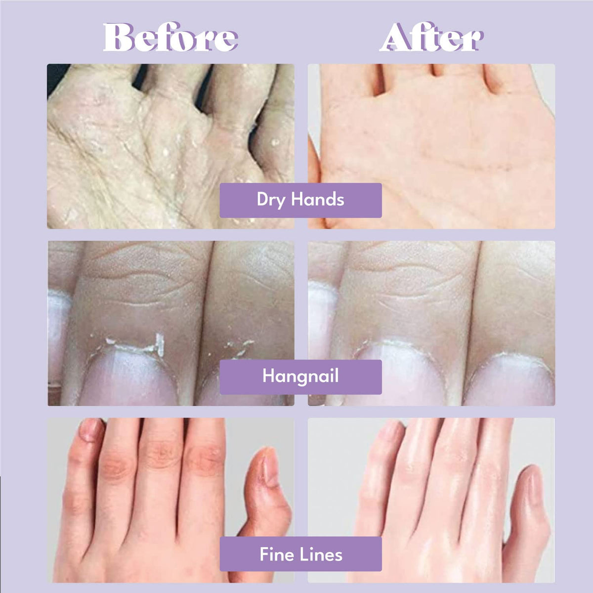 TOI:L glove worn on hand during 20-minute treatment for convenience
