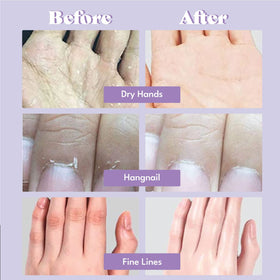 TOI:L glove worn on hand during 20-minute treatment for convenience