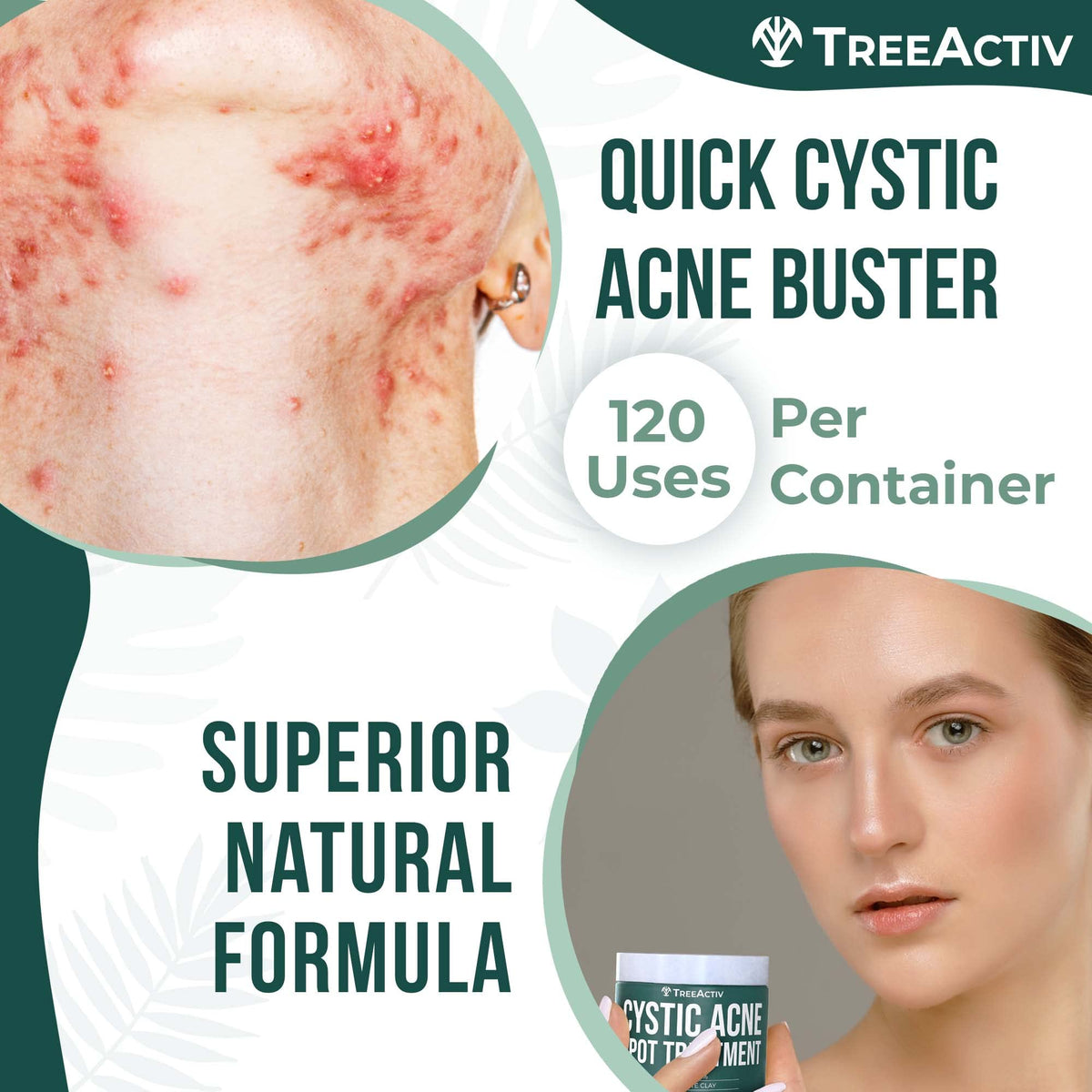 TreeActiv paste applied to chin demonstrating precise spot application