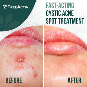 TreeActiv open jar paste texture highlighting concentrated treatment power