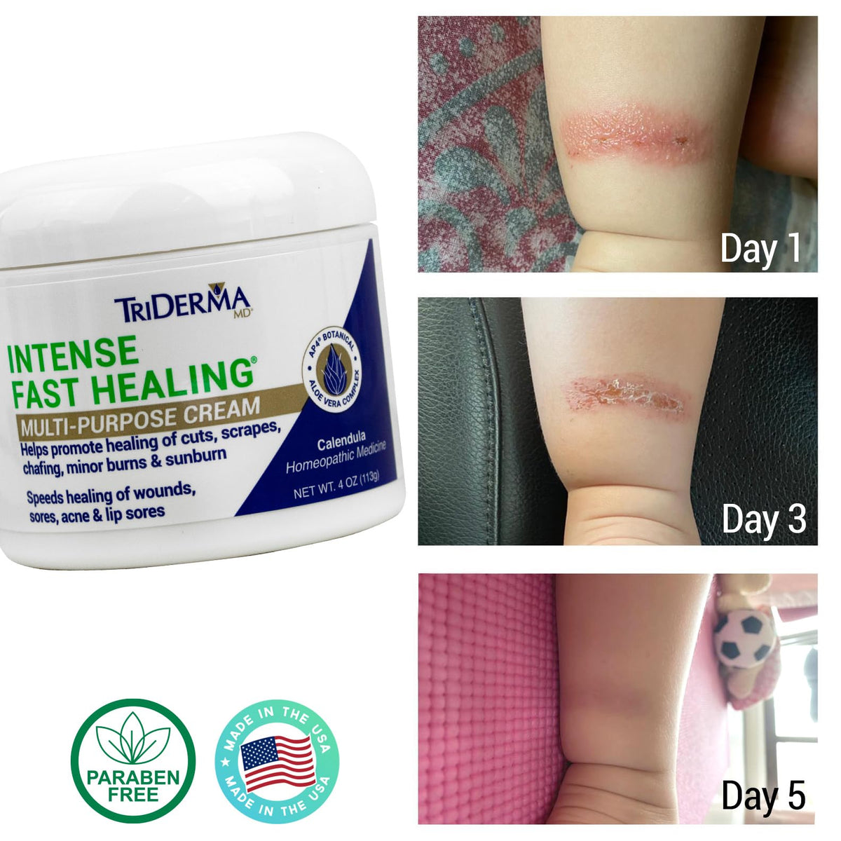 TriDerma cream texture on fingertip, demonstrating non-greasy quick-absorb benefit