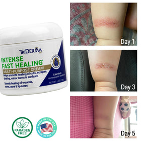 TriDerma cream texture on fingertip, demonstrating non-greasy quick-absorb benefit