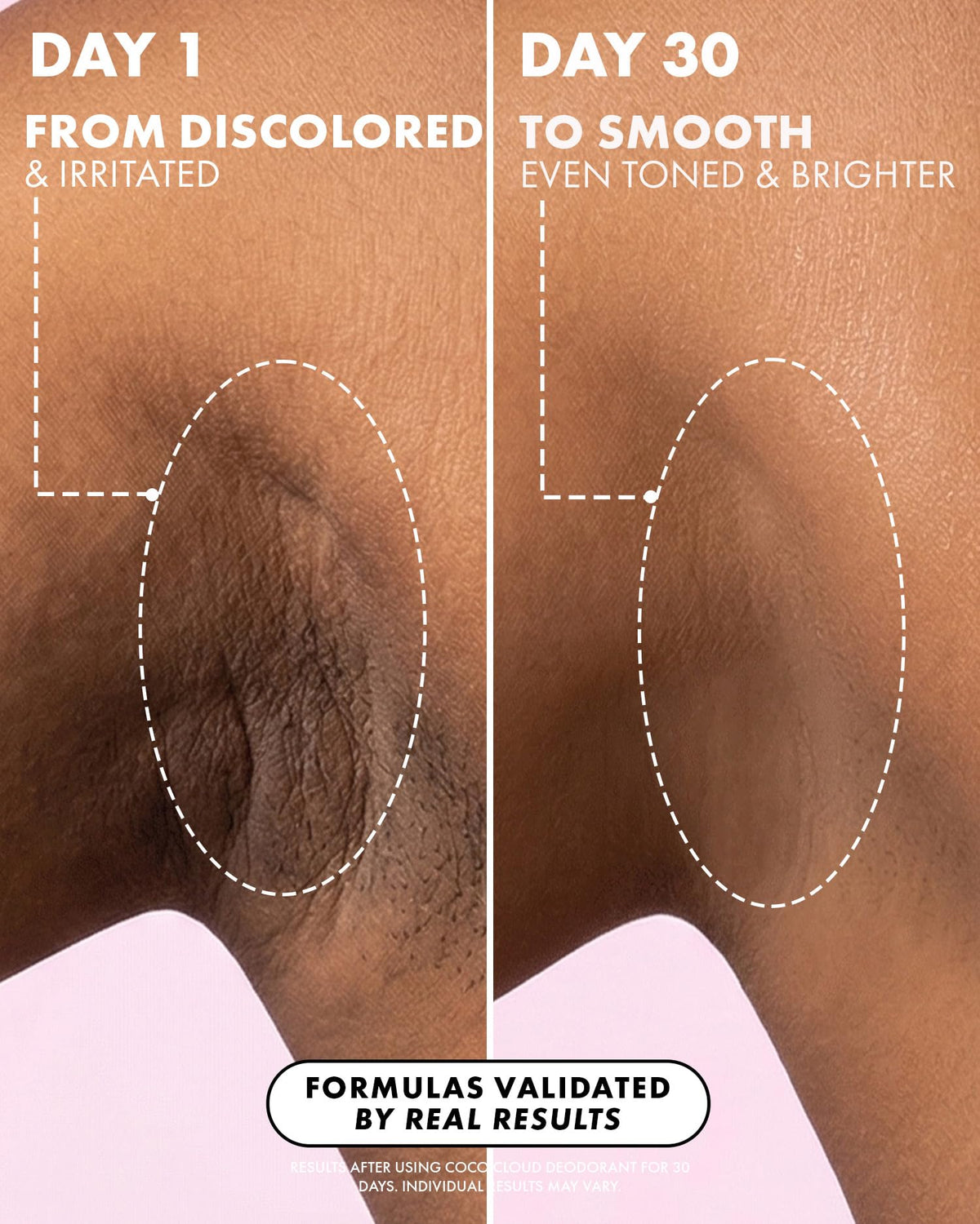 Applying Truly Coco Cloud after shaving to soothe and reduce bumps
