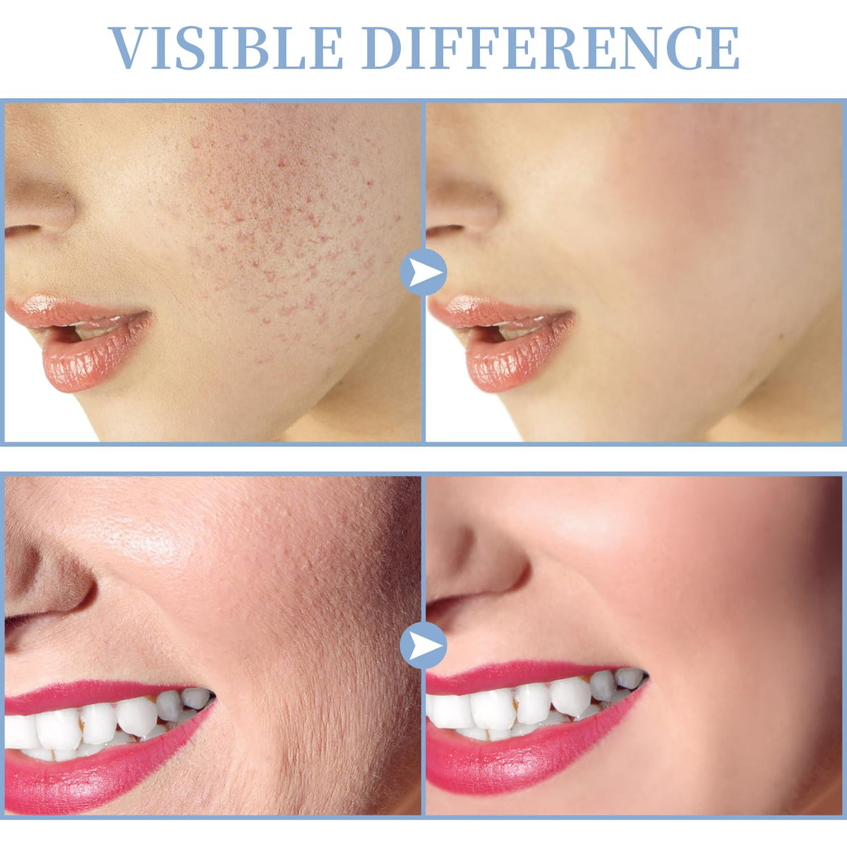 TUMAKOU mushroom tube used on cheek for broad coverage benefit