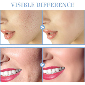 TUMAKOU mushroom tube used on cheek for broad coverage benefit