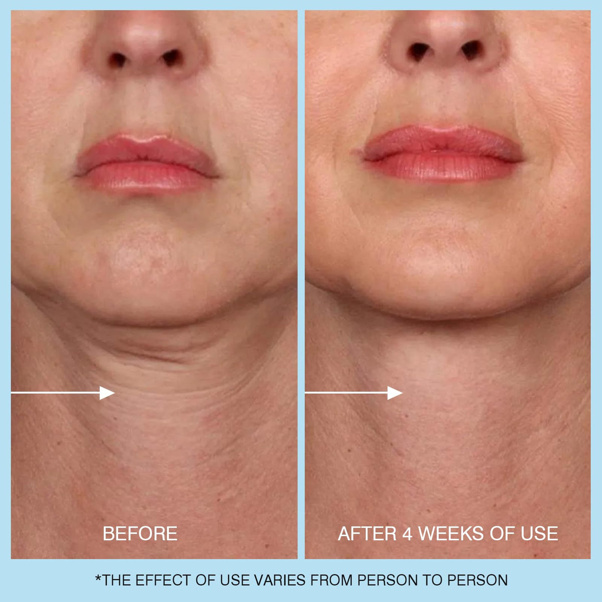 UJhay simulated before and after to illustrate improved skin texture