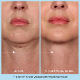 UJhay simulated before and after to illustrate improved skin texture