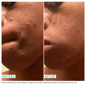 Urban Skin Rx label showing active ingredients Salicylic Acid and Sulfur benefit