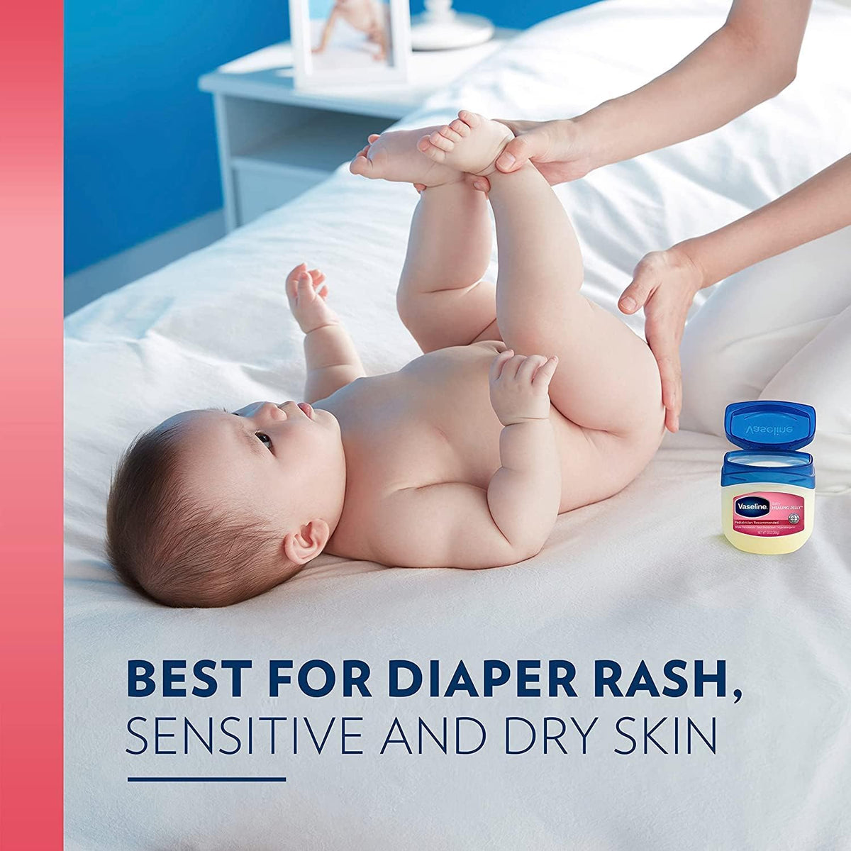 Vaseline being applied to infant leg to reduce diaper chafing