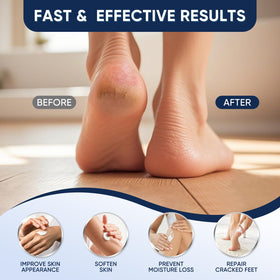 VREKEF before and after callus comparison showing smoother heels