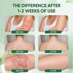WNOHIQ Healora applied on inner thighs for moisture protection
