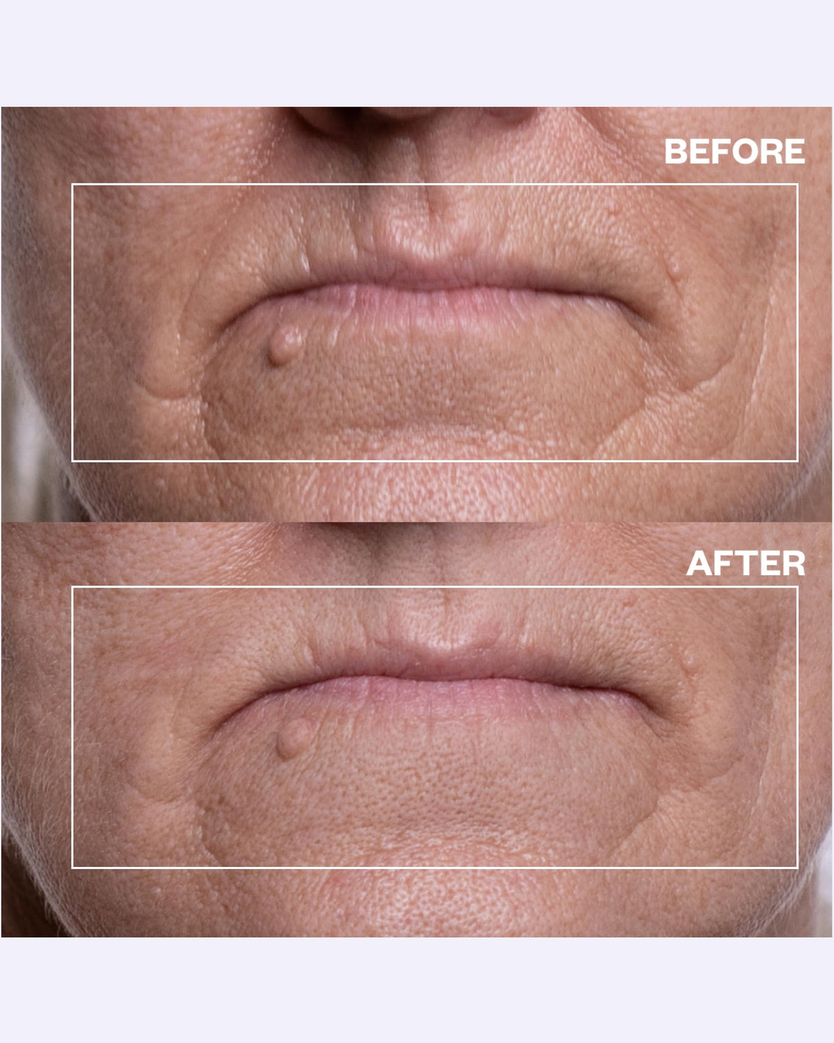 Wrinkles Schminkles patch applied above and below lips demonstrating wrinkle smoothing