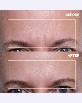 Wrinkles Schminkles patch worn on forehead demonstrating wrinkle reduction and comfortable daytime or sleep use