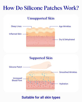Wrinkles Schminkles patch on side profile targeting marionette lines for refinement