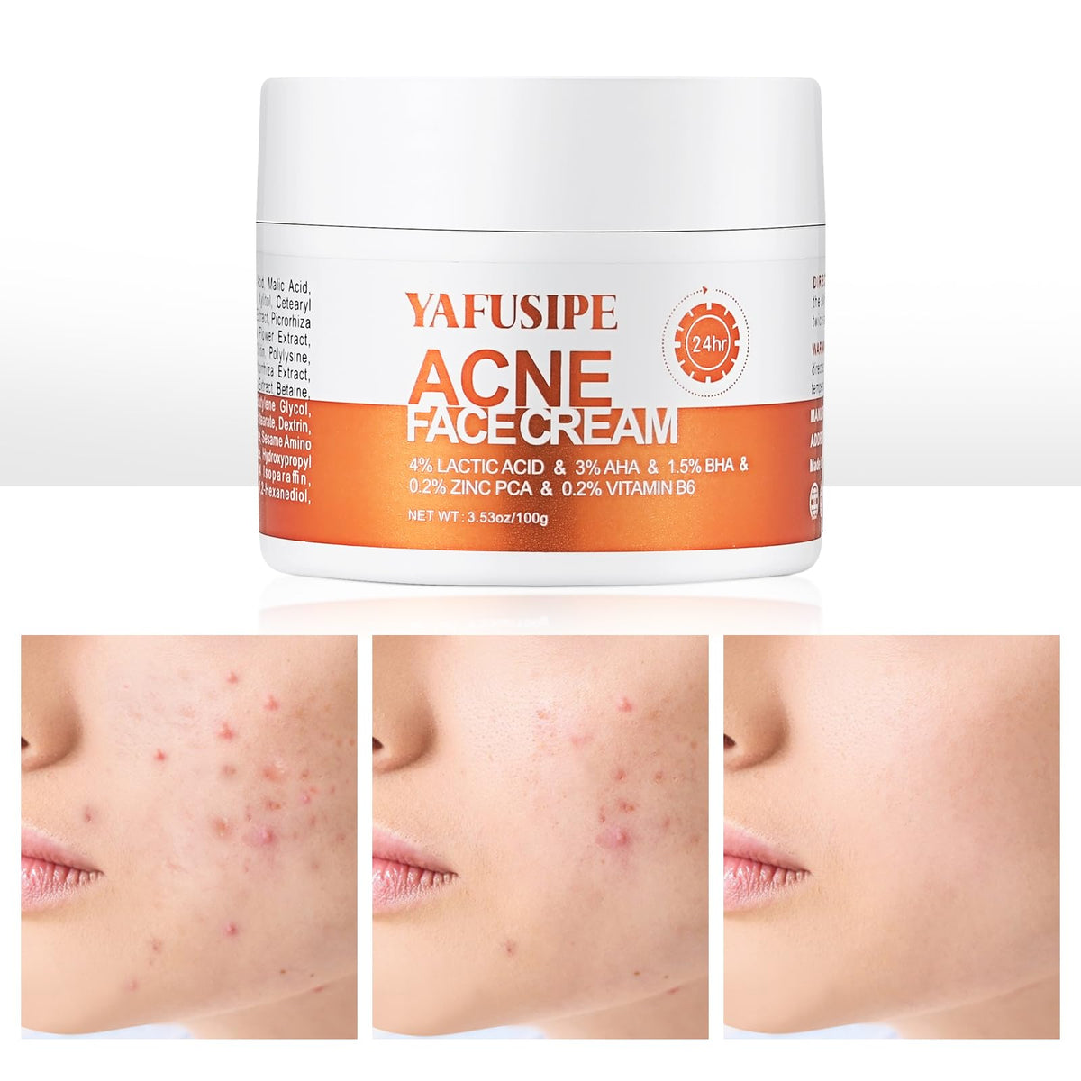 YAFUSIPE front tube acne treatment showing label and packaging for spot control