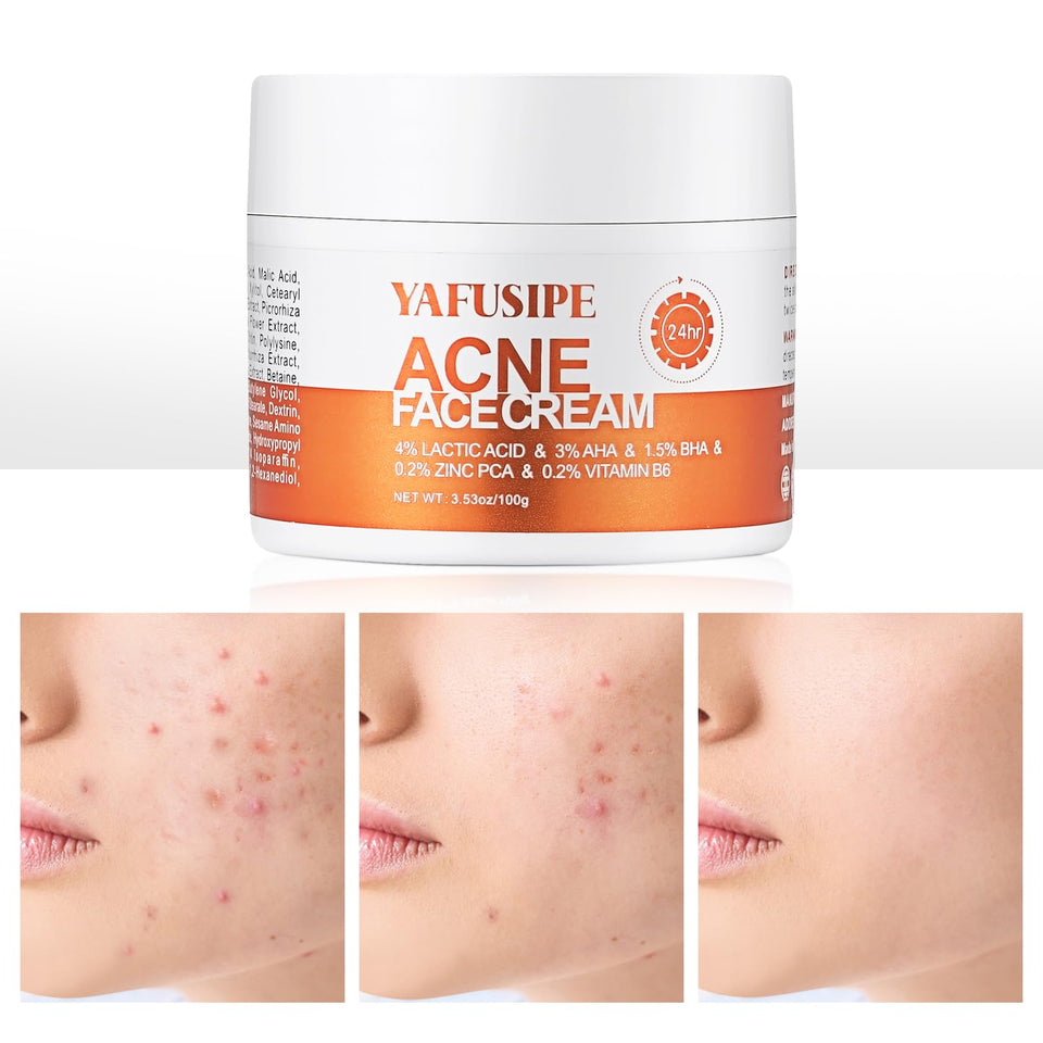 YAFUSIPE front tube acne treatment showing label and packaging for spot control