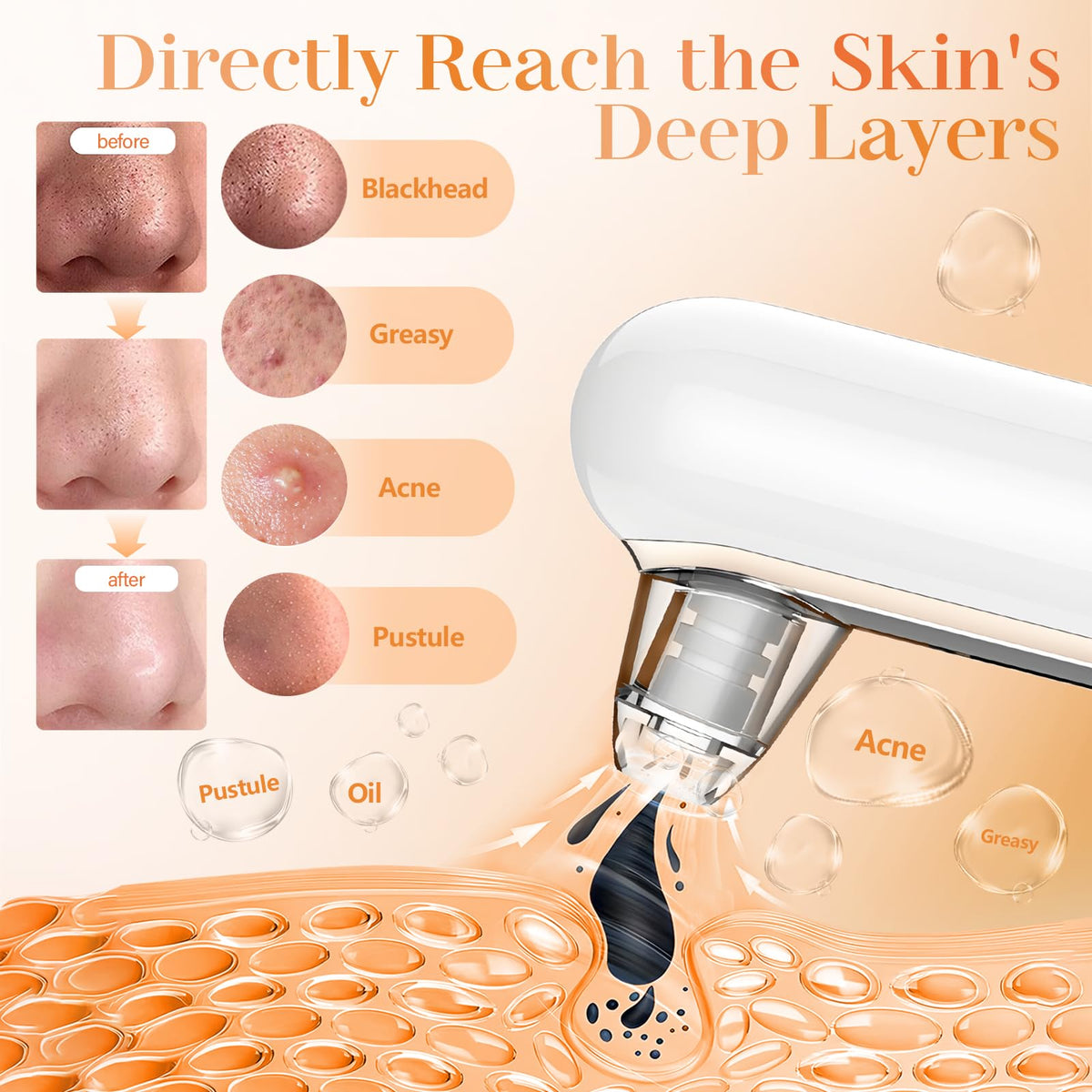 Yccu in use on nose demonstration showing effective blackhead removal benefit