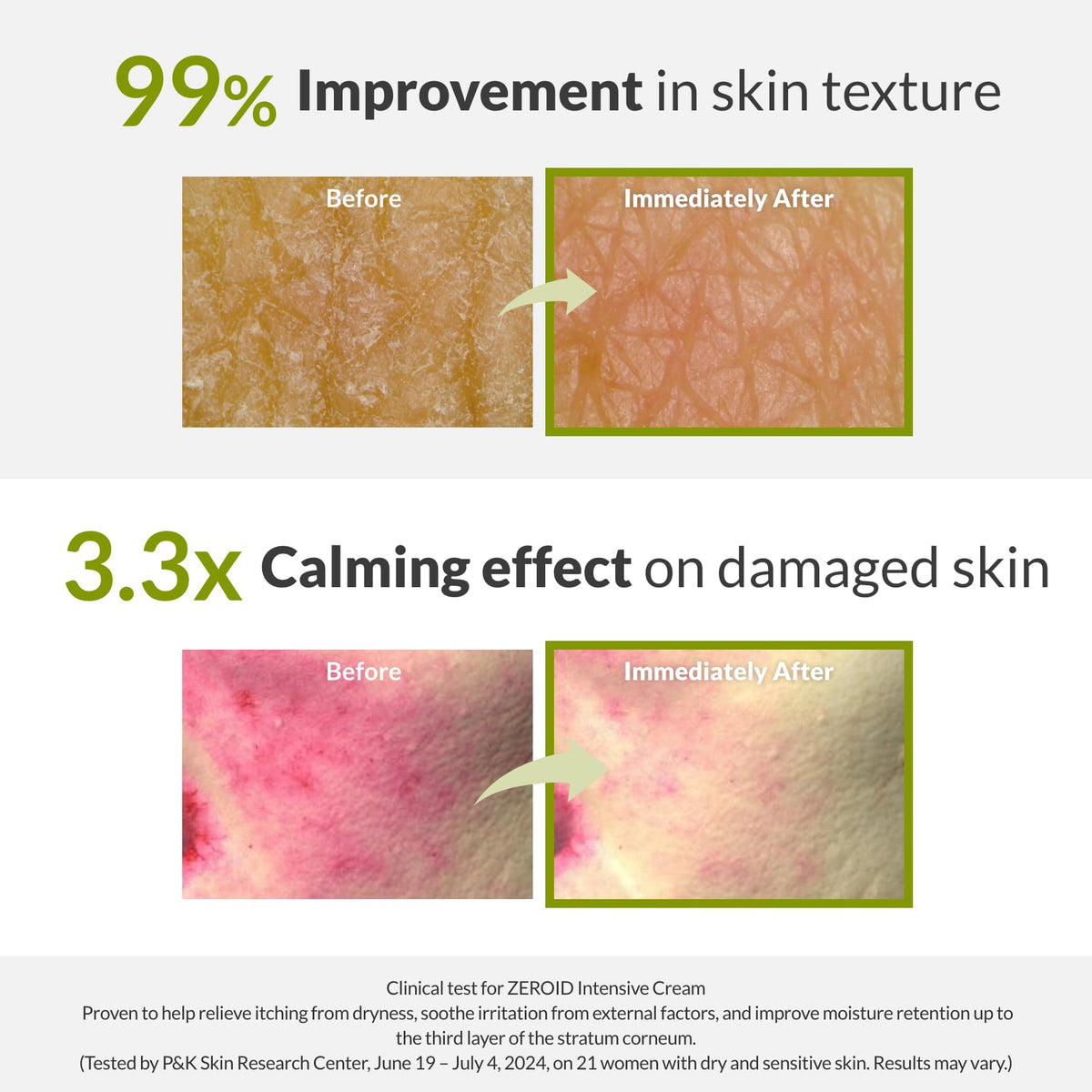 ZEROID cream being applied to hand demonstrating instant comfort and smoothness