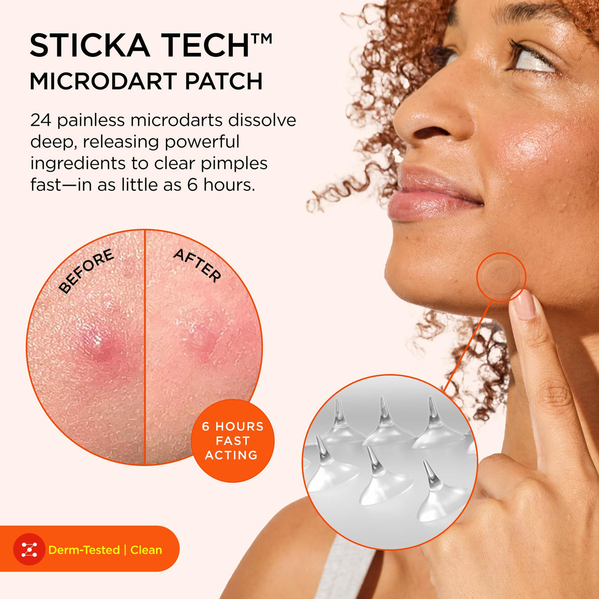 ZitSticka microdart patch close-up highlighting precision delivery