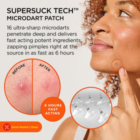 ZitSticka microdart close-up revealing dissolving needles for precise delivery