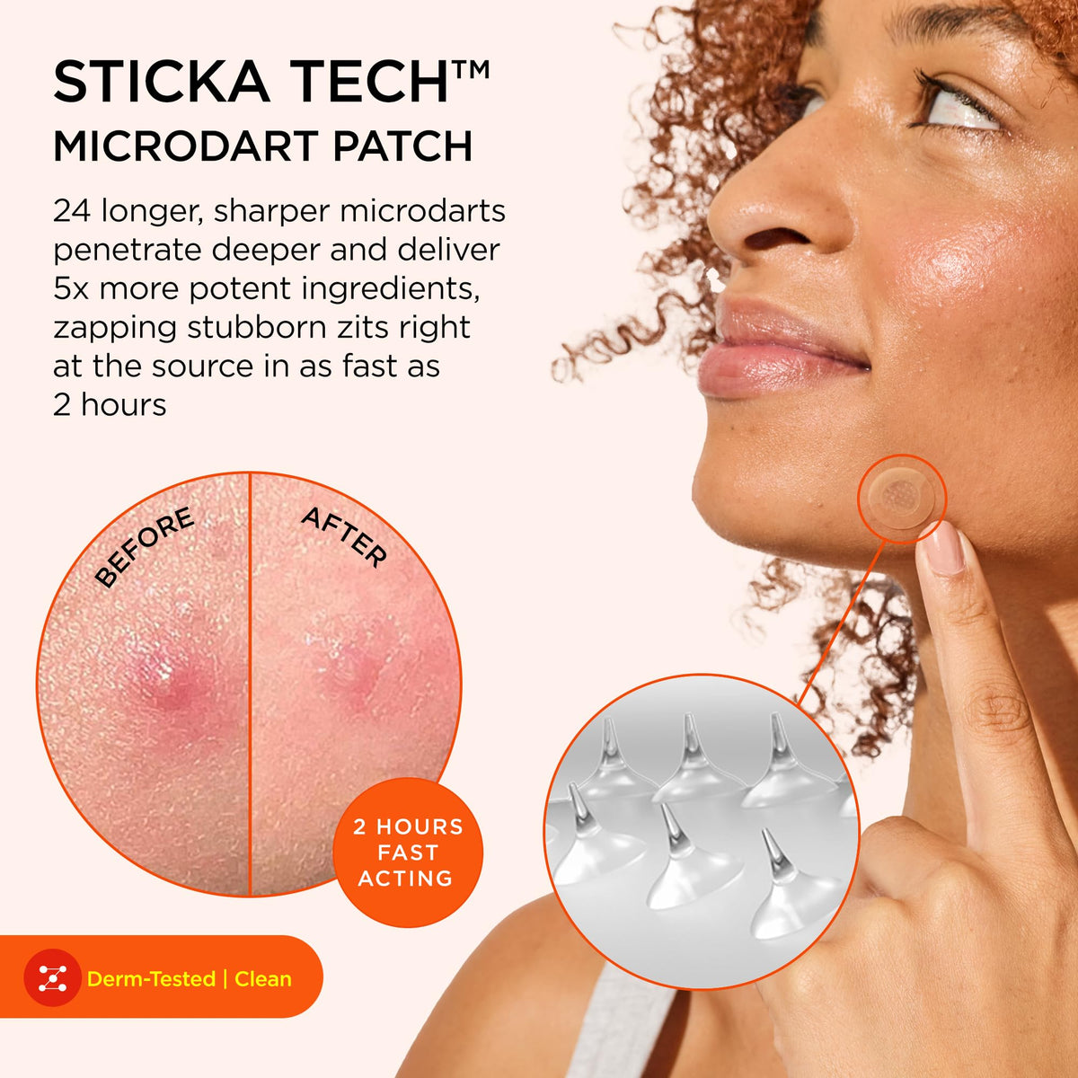 ZitSticka patch close-up displaying adhesive and clear design