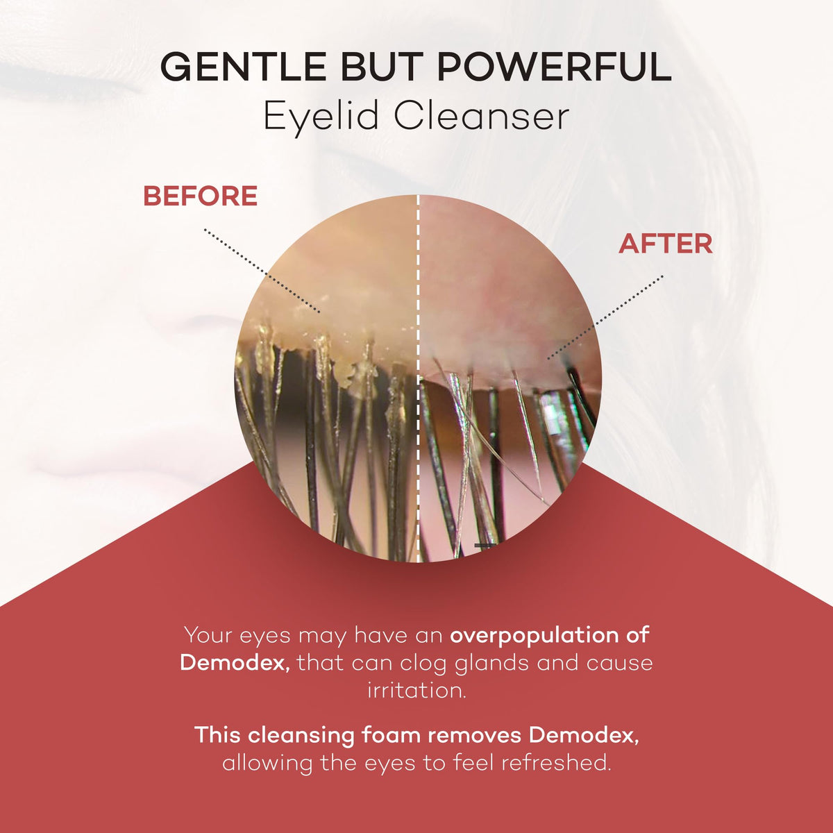 Zocular applying foam to closed eyelid to show safe, precise cleansing and reduced residue