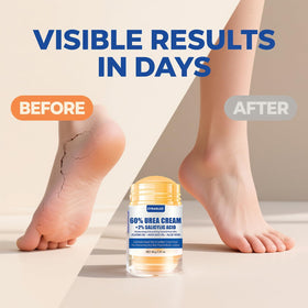 ZyraGloz application on heel in use demonstrates targeted callus softening